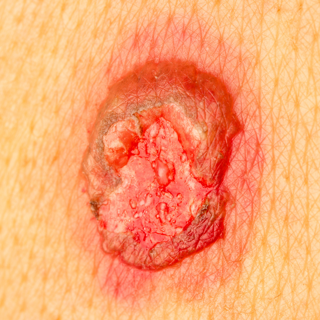 red, inflamed wound - LP