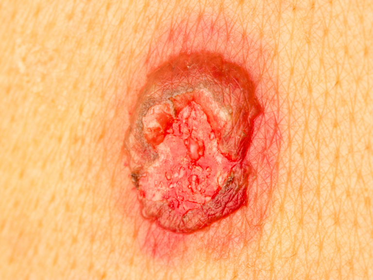 red, inflamed wound